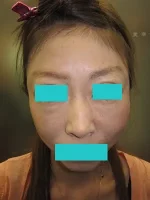 若返りの施術後