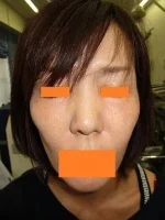 頬、こめかみへのヒアルロン酸の施注前