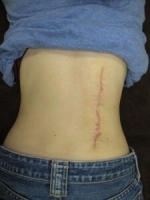 タトゥー（刺青）除去の2回目術後