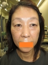 術前。正面。