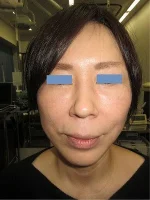 目の下のタルミ取り（ハムラ法）の術後