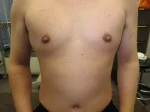 乳頭縮小（男性）（FtM）の術前