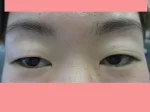 眼瞼下垂の術前