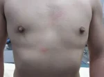乳頭縮小（男性）の術前