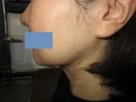 二重あごの治療（顎下の脂肪摘出術）の術後