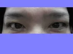 眼瞼下垂の術後