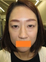 眼瞼下垂+上眼瞼タルミ取り+経結膜脱脂法の術前