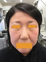 経結膜脱脂法（目の下のふくらみ取り）の術前