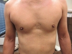 乳頭縮小（男性）の術前