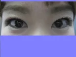 眼瞼下垂の術後