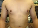 乳頭縮小（男性）の術後
