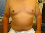 乳頭縮小（男性）の術後