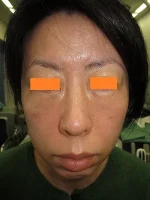 経結膜脱脂法（目の下のふくらみ取り）の術前