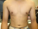乳頭縮小（男性）の術前