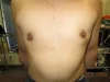 乳頭縮小（男性）（FtM）の術後