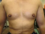 乳頭縮小（男性）の術前