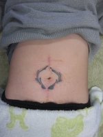 タトゥー（刺青）切除の1回目切除後