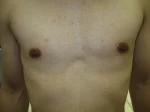 乳頭縮小（男性）の術後