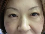 二重瞼（部分切開法）の術後