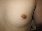 術後。左乳頭。