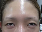 二重瞼（埋没法）の注射前