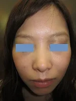 鼻翼縮小の術後