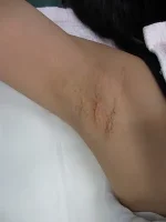 わきの傷跡修正の術前