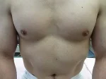 乳頭縮小（男性）の術前