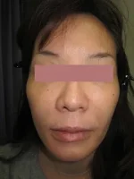 頬をふっくらさせるの治療前