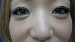 眼の下の二重の術後