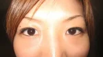 二重瞼（埋没法）の術後