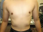 乳頭縮小（男性）の術後