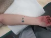 タトゥー（刺青）除去の術前