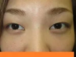 二重瞼（埋没法）の術前
