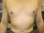 乳頭縮小（男性）の術前