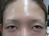 二重瞼（切開法）、眼瞼下垂の術前