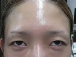 二重瞼（切開法）、眼瞼下垂の術前