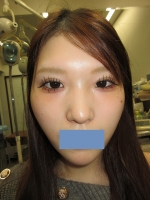 術後。正面。