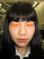 鼻翼縮小の術前