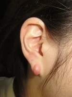 ピアスケロイドの術前