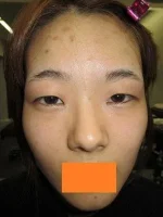 二重瞼（埋没法）の術前