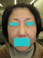 経結膜脱脂法（目の下のふくらみ取り）の術後