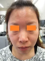 鼻翼縮小の術前