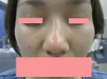 隆鼻　ヒアルロン酸の術後