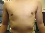 乳頭縮小（男性）の術前