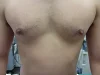 乳頭縮小（男性）の術前