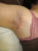 術前。　右腋窩。