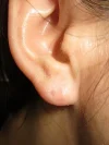 ピアス後の耳垂裂の術後