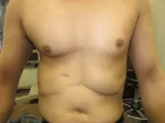 乳頭縮小（男性）の術後