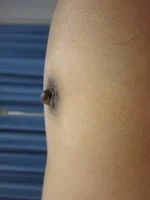 乳頭縮小（女性）の術後